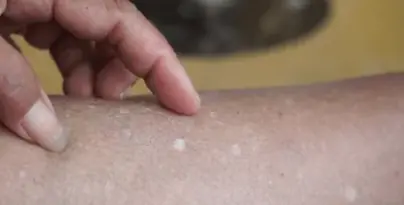 ทำไมคนวัย 40+ ชอบมี "จุดขาวปริศนา" ขึ้นตามตัว? หมอผิวหนังเปิดสาเหตุแท้จริง