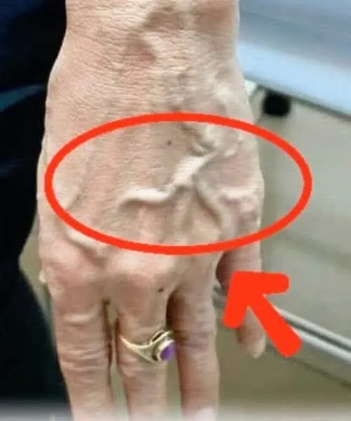 ทำไมเส้นเลือดของคุณจึงโป่งพองและมองเห็นได้ชัดขึ้นอย่างกะทันหัน?