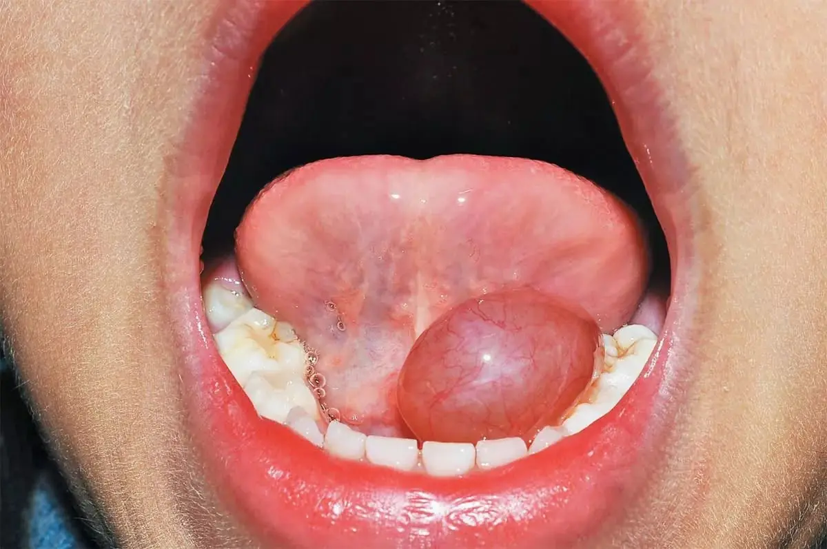 อย่ามองข้าม! หากมี “ก้อนหรือตุ่ม” ในปาก อาจเป็นสัญญาณเตือนของโรคบางอย่า