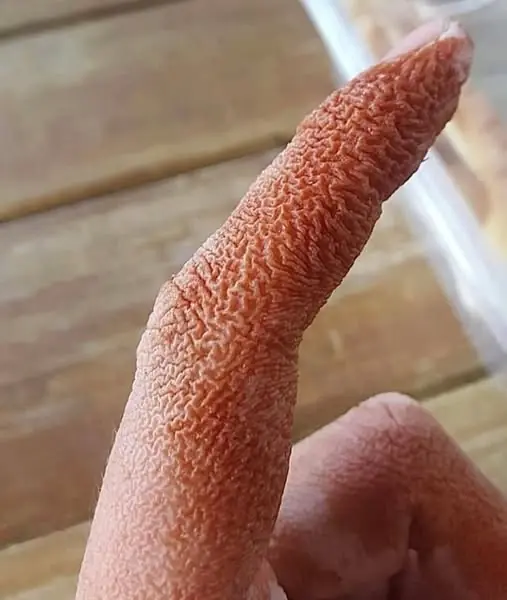 สังเกตผิวมือเหี่ยวย่นผิดปกติ สัญญาณเตือนที่ไม่ควรมองข้าม