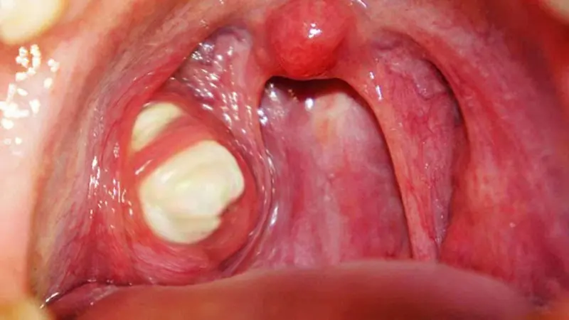 ไขข้อข้องใจก้อนสีขาวในลำคอ พร้อมวิธีดูแลอย่างถูกวิธี