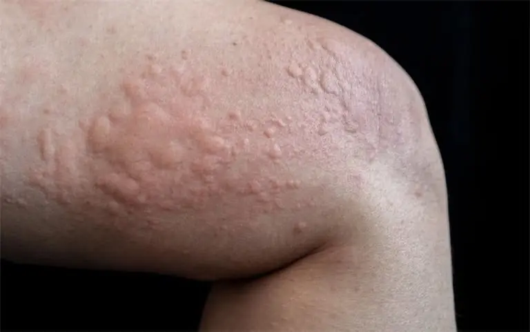 ระวังให้ดี หากร่างกายของคุณคัน และมีตุ่มแบบนี้ปรากฏบนผิวหนังของคุณ...