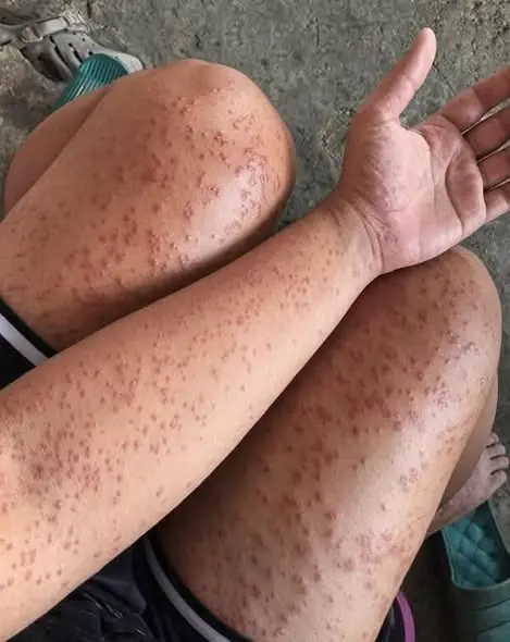 ผื่นจุดแดงทั่วแขนและขา สังเกตอย่างไร และควรดูแลผิวแบบไหน