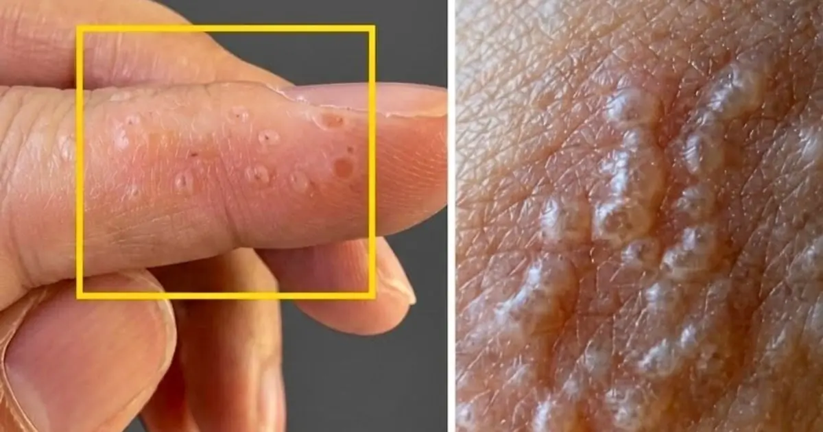 ตุ่มใสเล็ก ๆ บนนิ้วมืออาจบอกอะไร? รู้จักสาเหตุ อาการ และวิธีดูแลผิวอย่างเหมาะสม