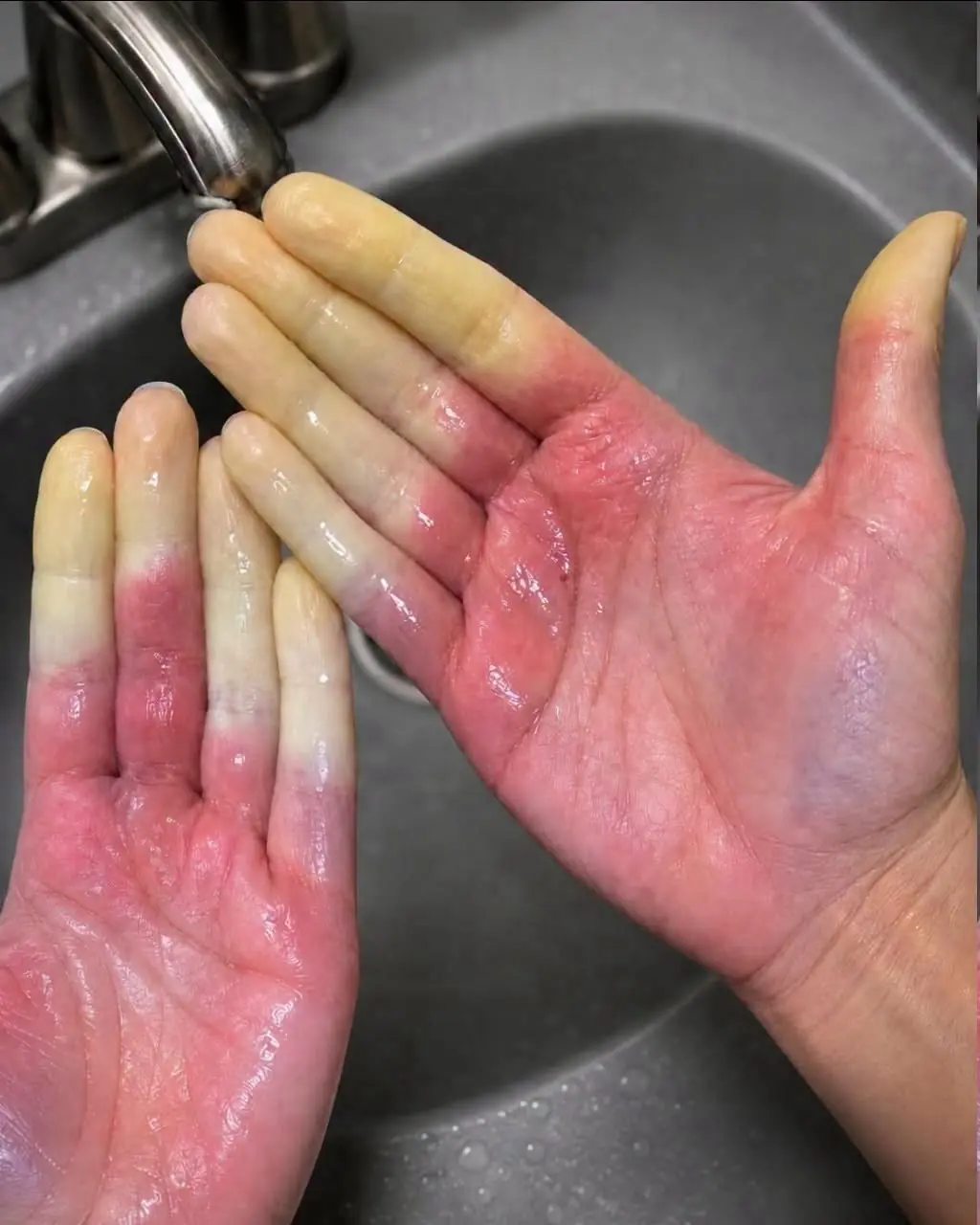 นิ้วมือซีดขาวผิดปกติ เกิดจากอะไร? สัญญาณที่ควรสังเกตและวิธีดูแลมืออย่างเหมาะสม