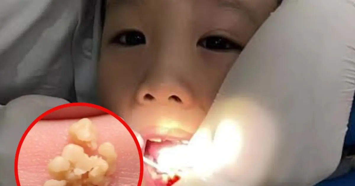 ลูกชายวัย 10 ขวบถูกเพื่อนล้อเรื่องกลิ่นปาก แม่พาไปตรวจพบสาเหตุที่ไม่ควรมองข้าม